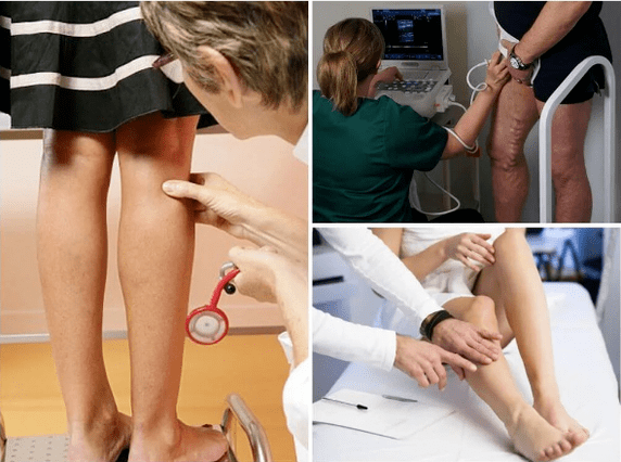 Varicose veins on their feet
