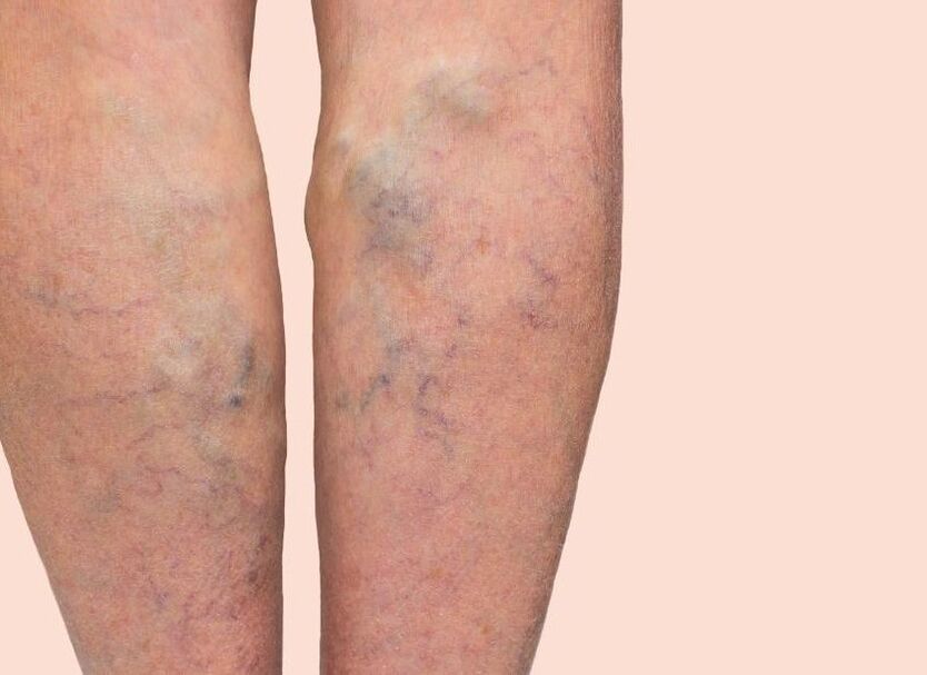 What varicose veins do look like