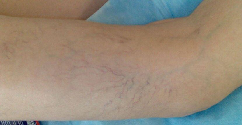 Vascular stars on their feet