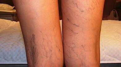 How to treat the spread of varicone on women in women