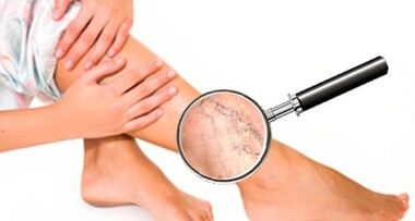 Causes of varicose veins