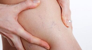 Signs and symptoms of varicose veins