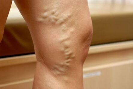Drugs for varicose veins