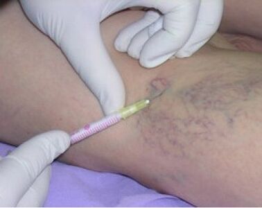 Varicose vein injections