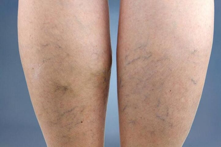 symptoms of varicose veins on the legs