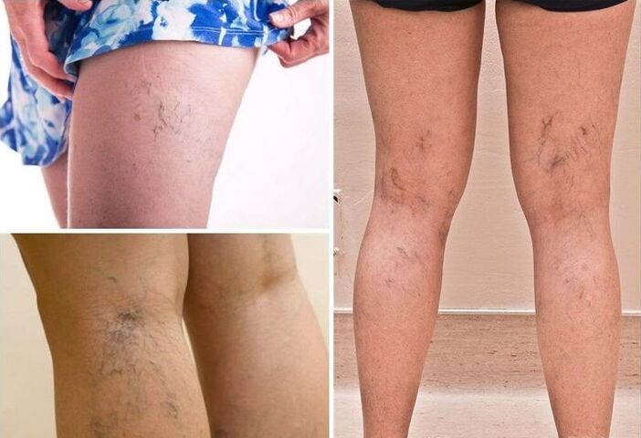 varicose veins on the legs