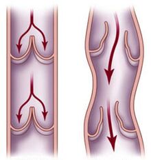 A healthy vein and impaired blood flow in varicose veins