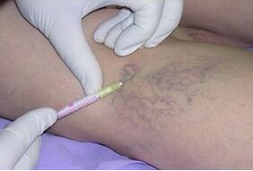 Sclerotherapy is a method of treating varicose veins on the legs