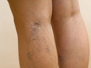 Veins sticking out from under the skin are a symptom of varicose veins on the legs